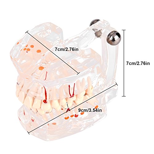Model zuba Model propadanja zuba Transparentni gingiv patološkim zubima Obrazovni model sa demonstracijama